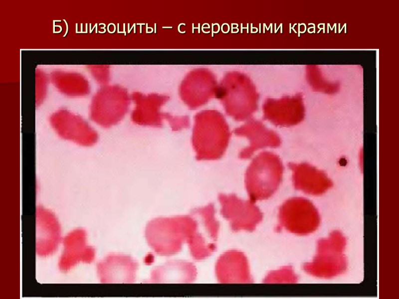 Б) шизоциты – с неровными краями